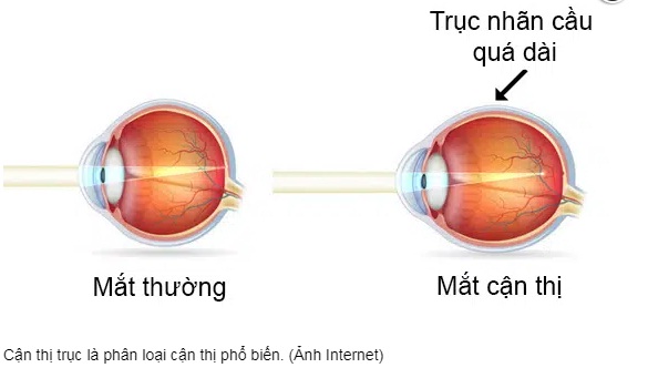 Phân loại cận thị theo mức độ
